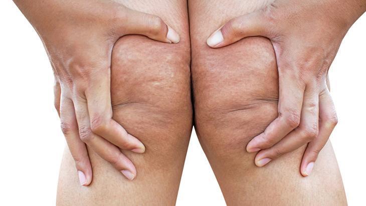 lipodem kadinlarin sessiz cigligi neden kilo veremiyorum diyenler icin cevap zFcdgHET.jpg